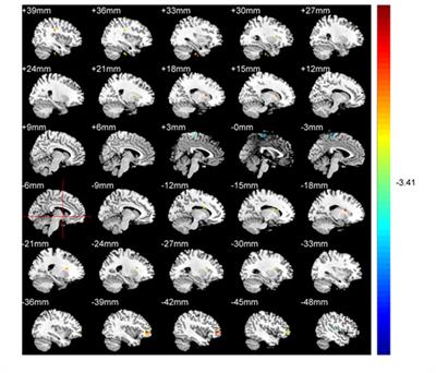 Investigating amplitude of low-frequency fluctuation and possible links with cognitive impairment in childhood and adolescence onset schizophrenia: a correlation study